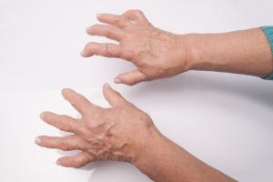 hands with rheumatoid arthritis